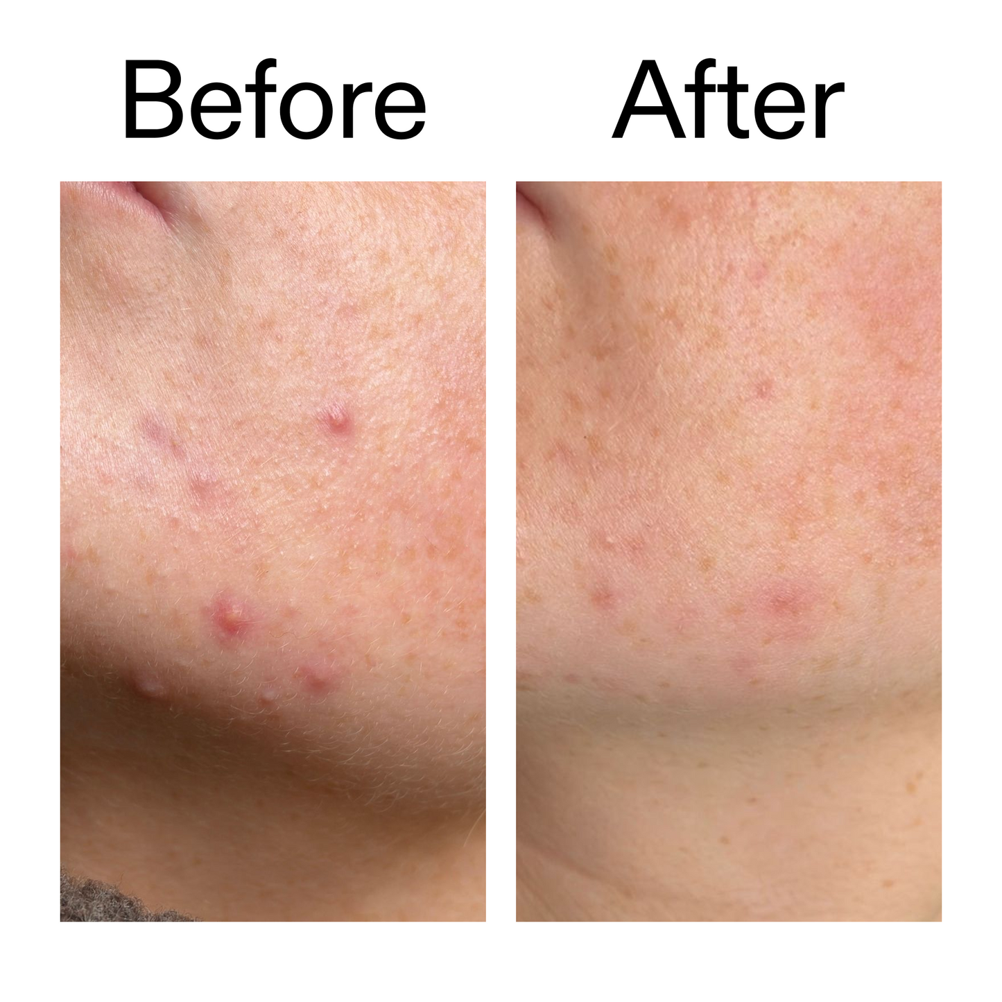 10-azelaic-acid-serum-for-redness-relief-g0 B_A_1_PPAGE.png