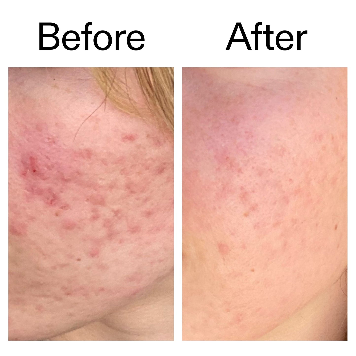 10-azelaic-acid-serum-for-redness-relief-g0 Azealic_Acid_Serum_B_A_Ppage_2000_x_2000.jpg