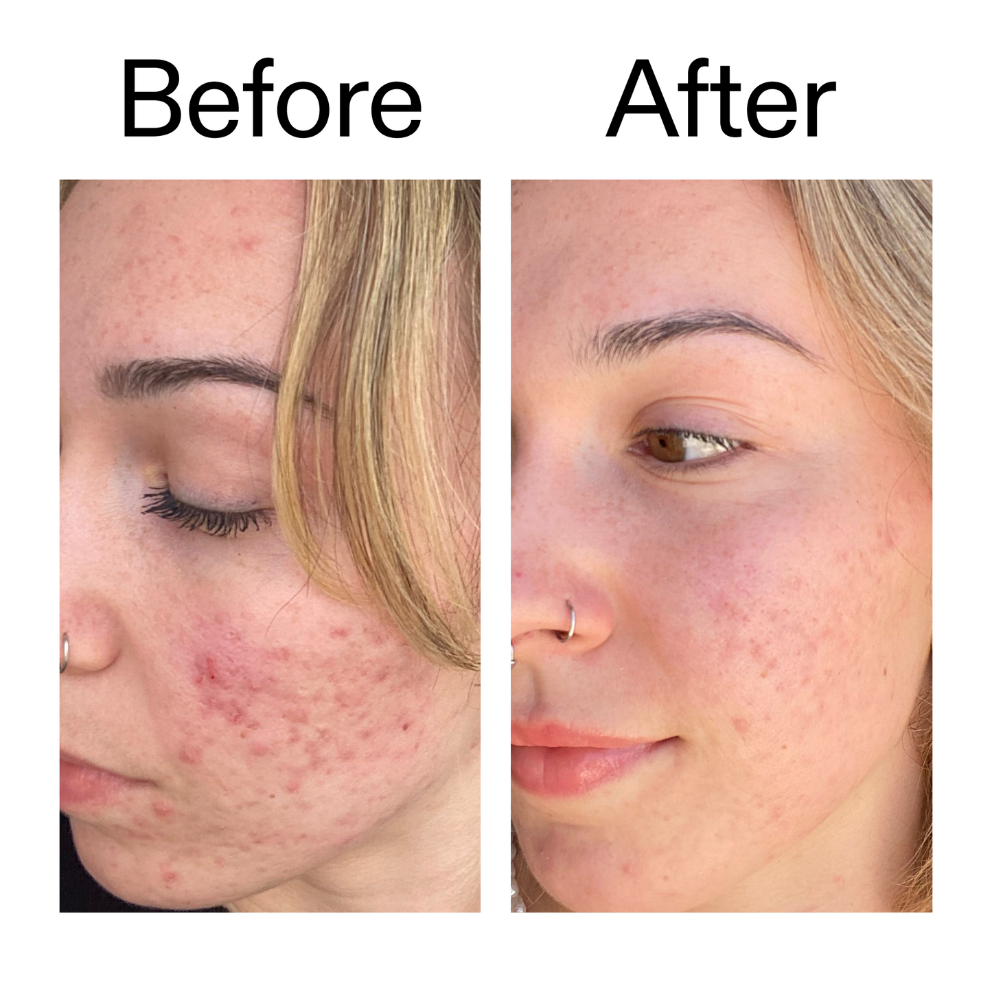 10-azelaic-acid-serum-for-redness-relief-g0 B_A_2_PPAGE.png
