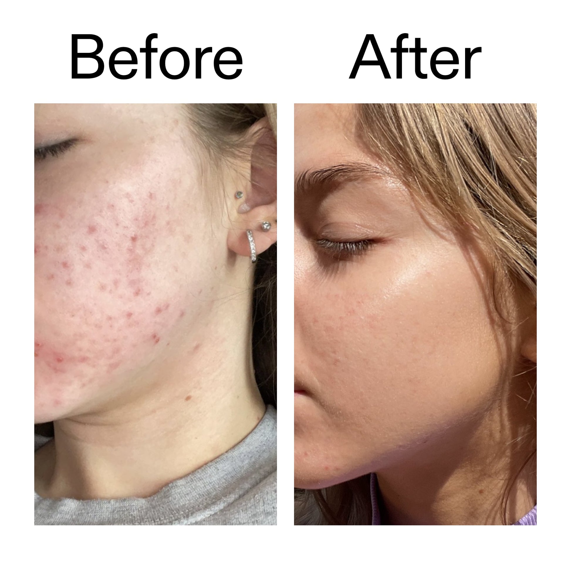 beta-hydroxy-acid-bha-serum-i0 Beta_Hydroxy_Acid_Serum_Before_After_2000x2000_96fda3e5-938d-49ef-bcf2-a0fa6ece4e2c.jpg