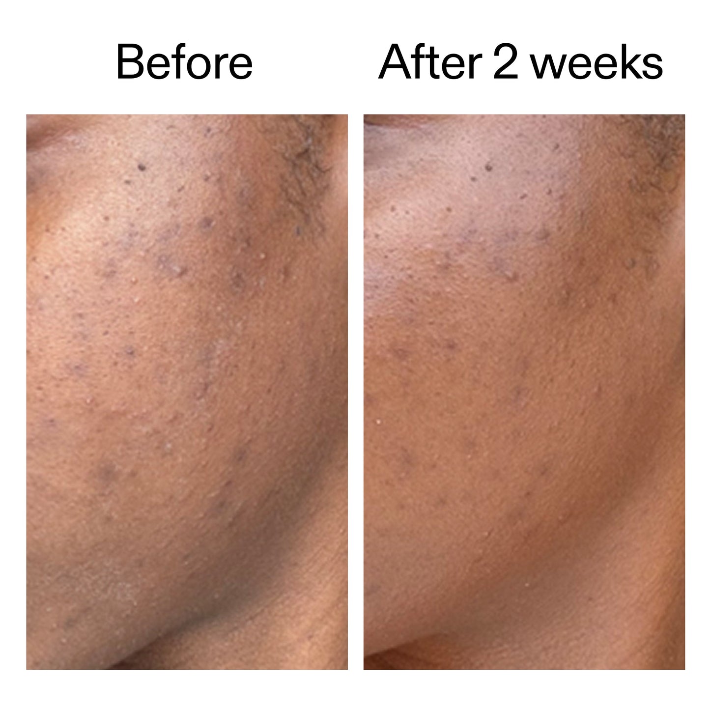 360-acne-clearing-duo-d5 DIOICB_A2000x2000.jpg