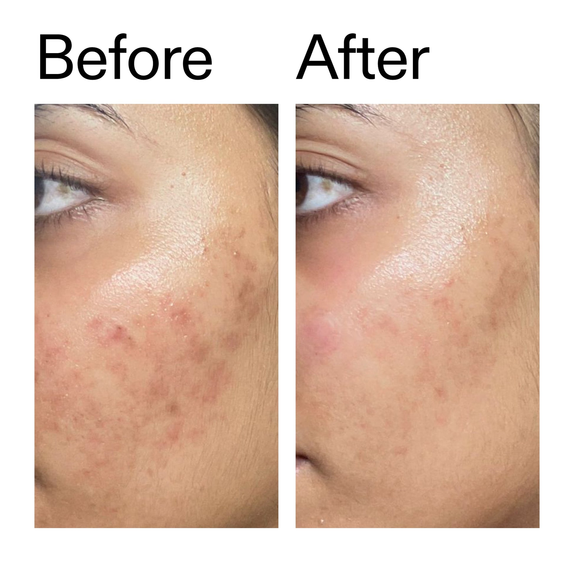 ectoin-hydro-barrier-serum-duo-e8 Ectoin_Hydro-barrier_Serum__Before_After_2000x2000_34261920-d004-48d0-9c7b-8e1c15971bfd.jpg