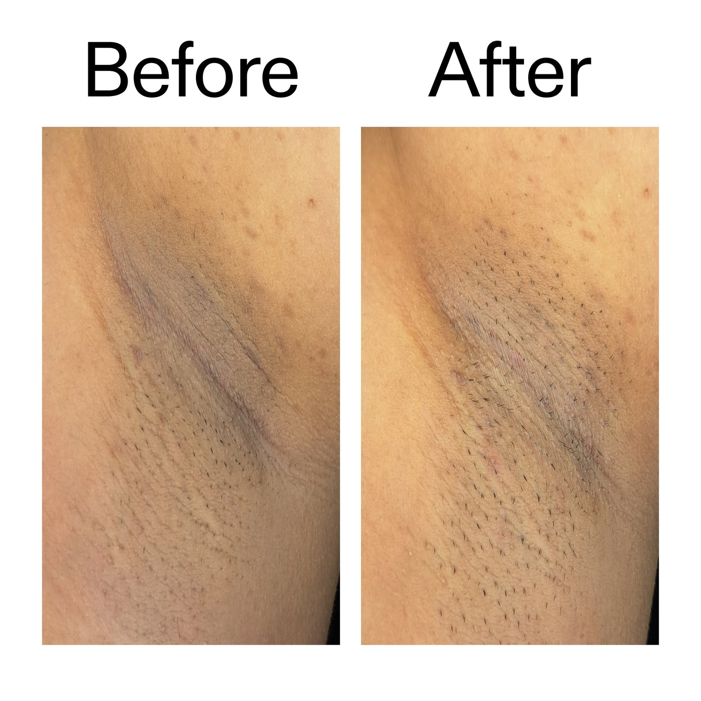 glycolic-acid-exfoliating-body-stick-duo-p7 Glycolic_Acid_Exfoliating_Body_Stick_Before_After_V3_2000x2000_ea919cd9-1439-4a46-82a0-76200eb5bb42.jpg
