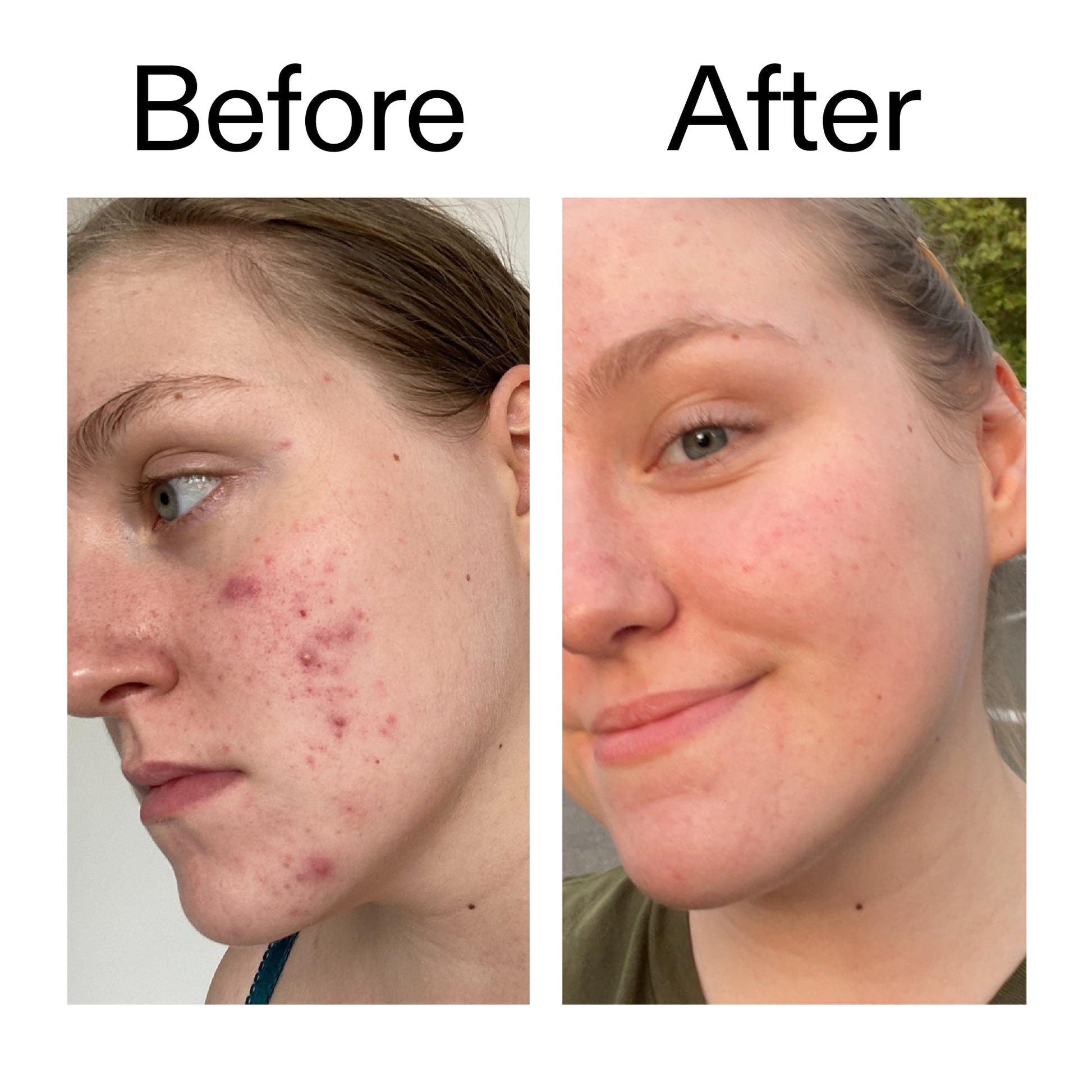 glycolic-acid-toner-w6 Glycolic_Acid_Toner_Before_After_2000x2000_49f0b9f7-e71b-4b2e-a8f8-2ea4b73247bb.jpg