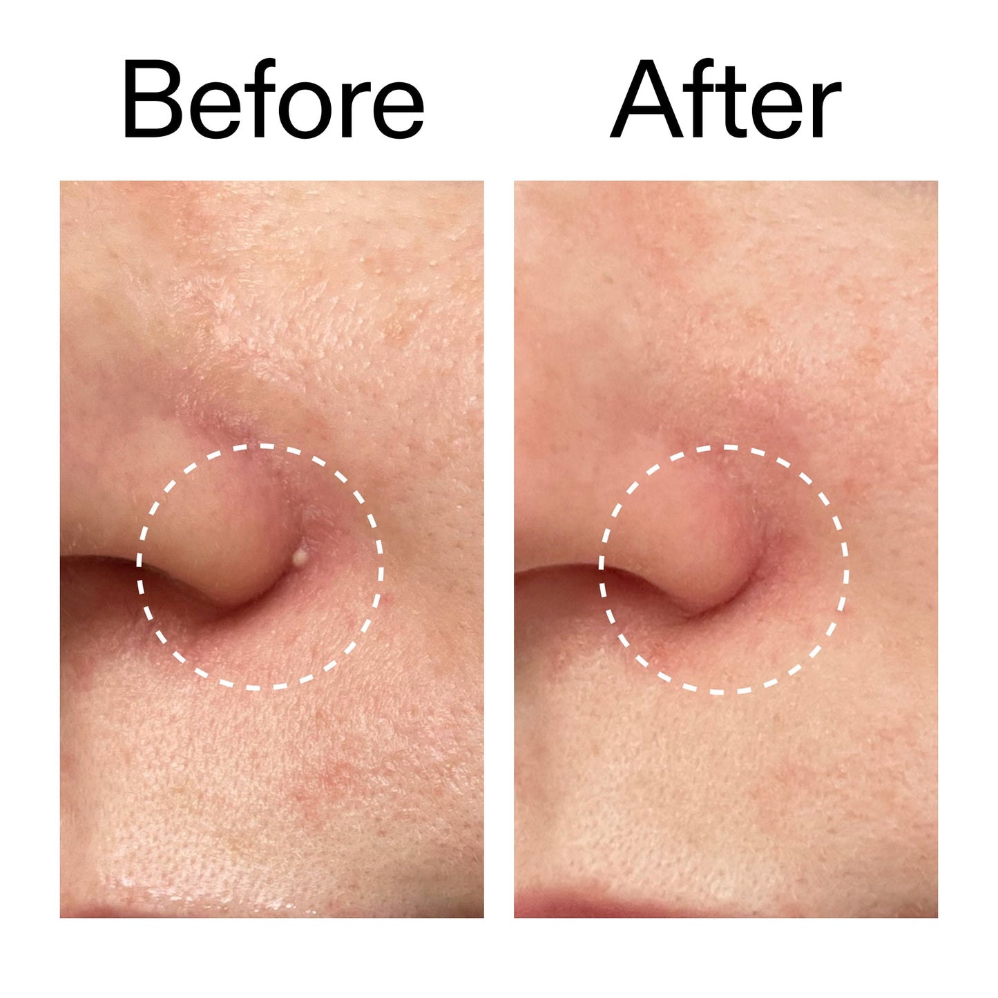 hydrocolloid-invisible-pimple-patches-pack-of-22-b0 Hydrocolloid_Invisible_Pimple_Patches_Before_After_2000x2000_b02aa37b-c78a-4682-91de-9135af5bb7df.jpg