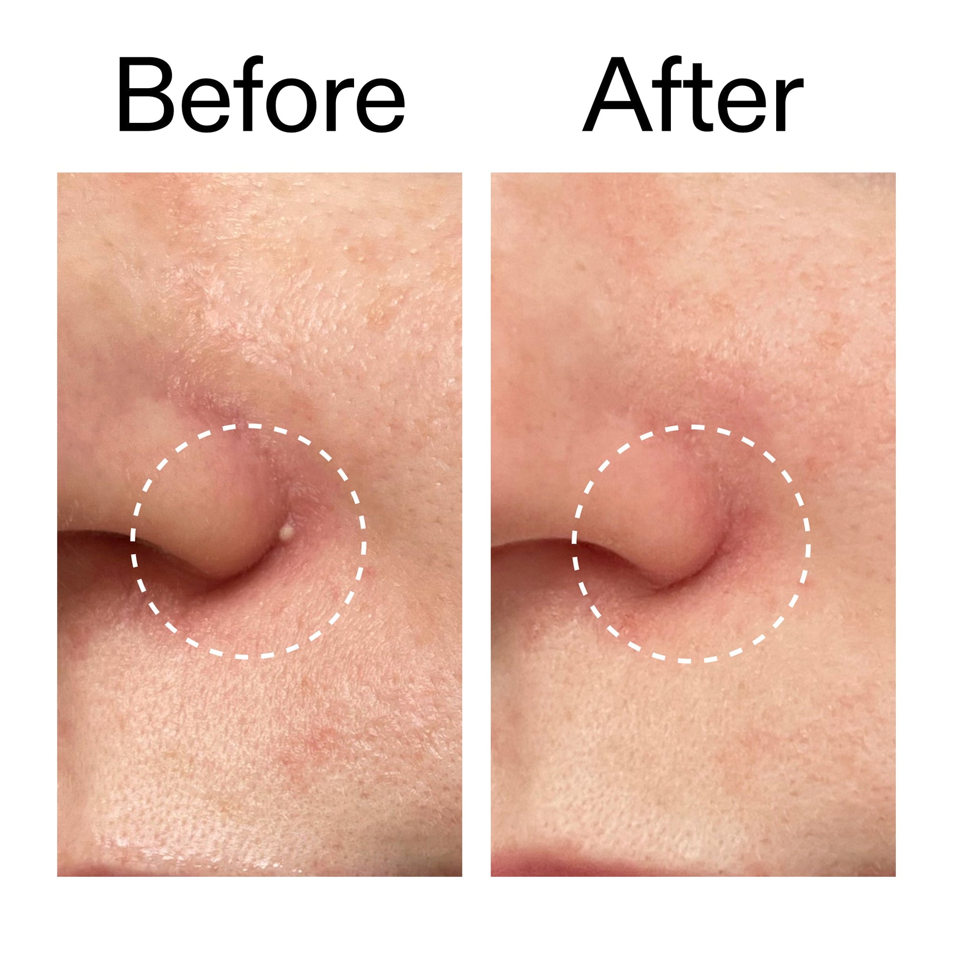 hydrocolloid-invisible-pimple-patches-pack-of-22-b0 Hydrocolloid_Invisible_Pimple_Patches_Before_After_2000x2000_b02aa37b-c78a-4682-91de-9135af5bb7df.jpg