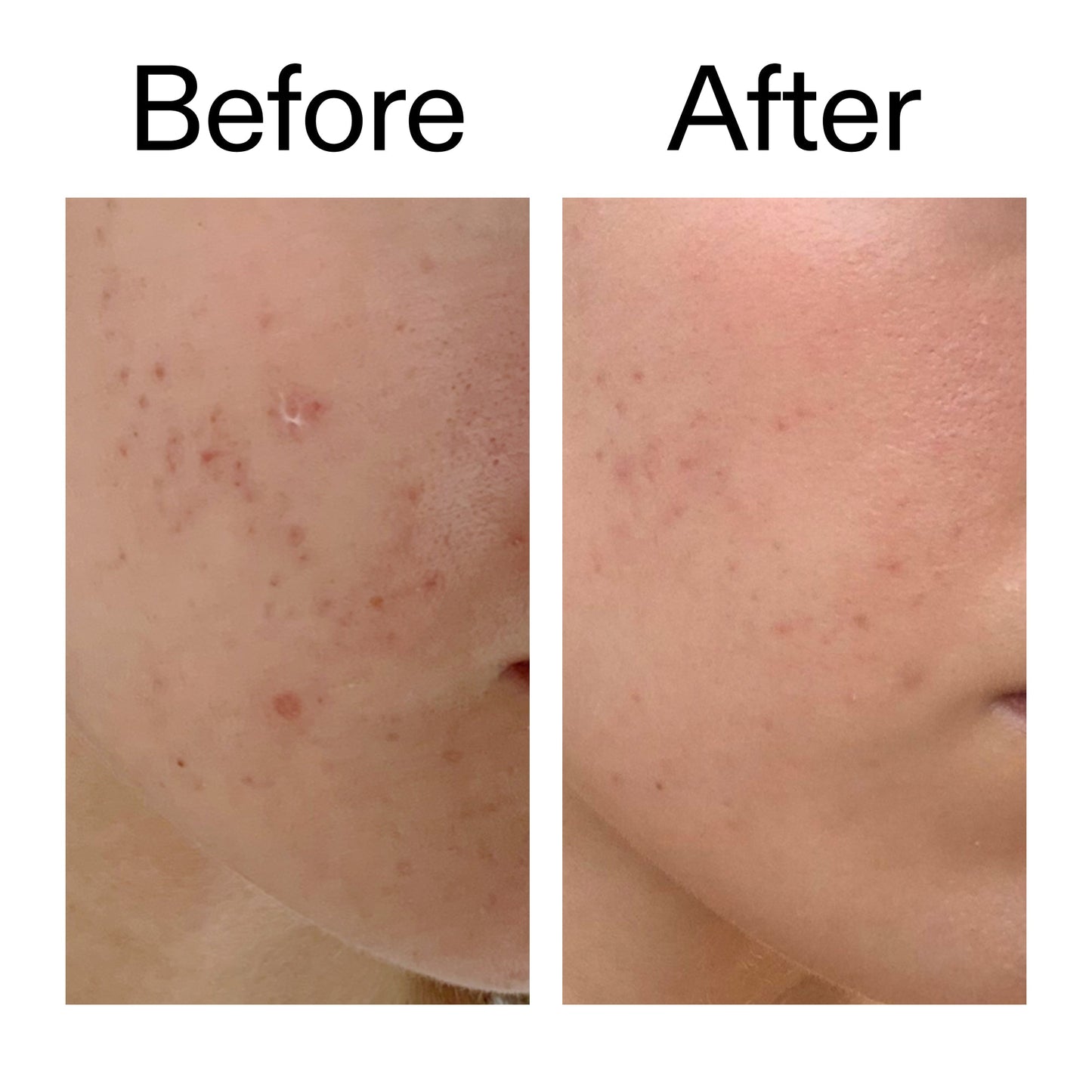 mandelic-acid-treatment-l1 Mandelic_Acid_Treatment_Before_After_2000x2000_4885ac6e-c5d7-4279-a72a-1417af7dce35.jpg
