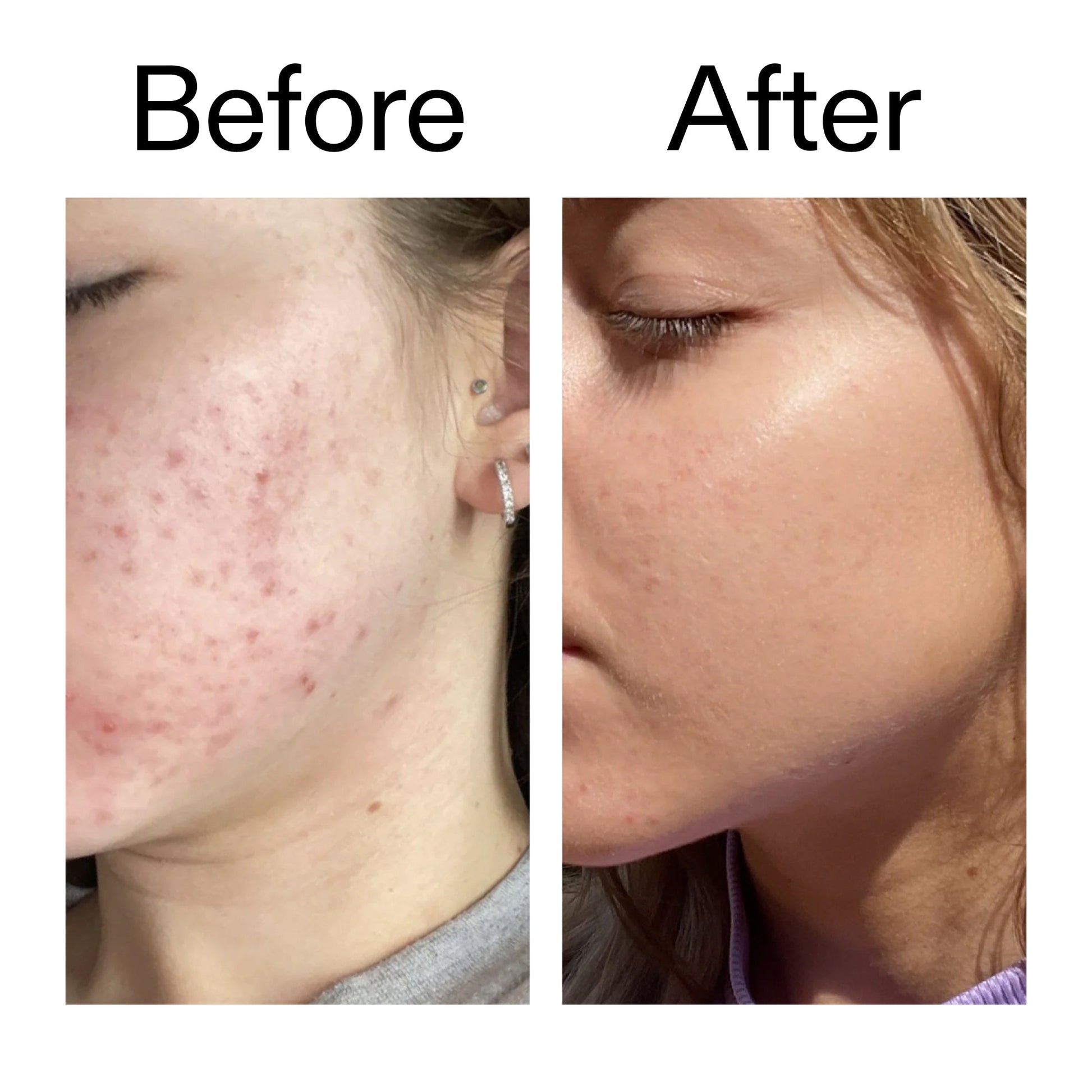 10-niacinamide-serum-duo-c6 Niacinamide_Serum_Before_After_2000x2000_bde32455-9e7d-448e-b053-bef41504f0a9.jpg