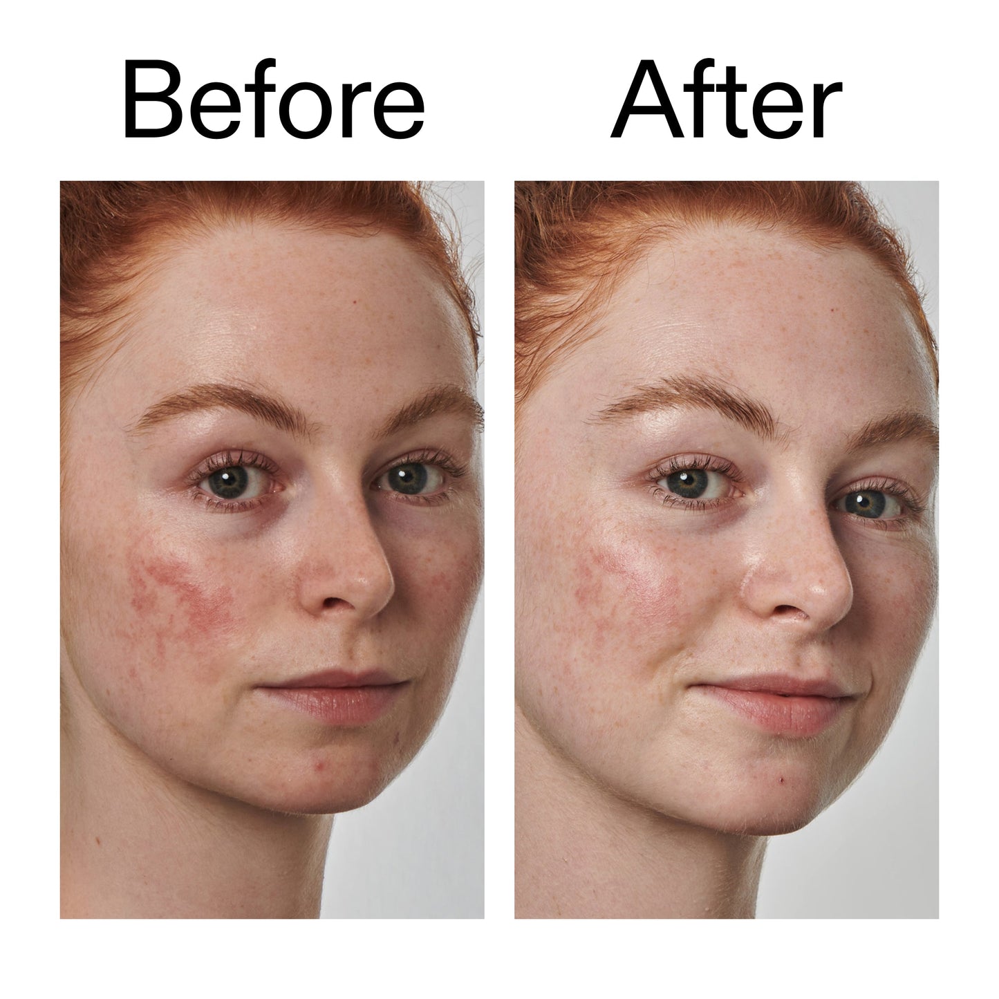 10-azelaic-acid-serum-for-redness-relief-g0 Redness_Relief_Serum_Before_After_2000x2000_3334dc9a-cce9-4e00-8aec-7ad89ca051f2.jpg