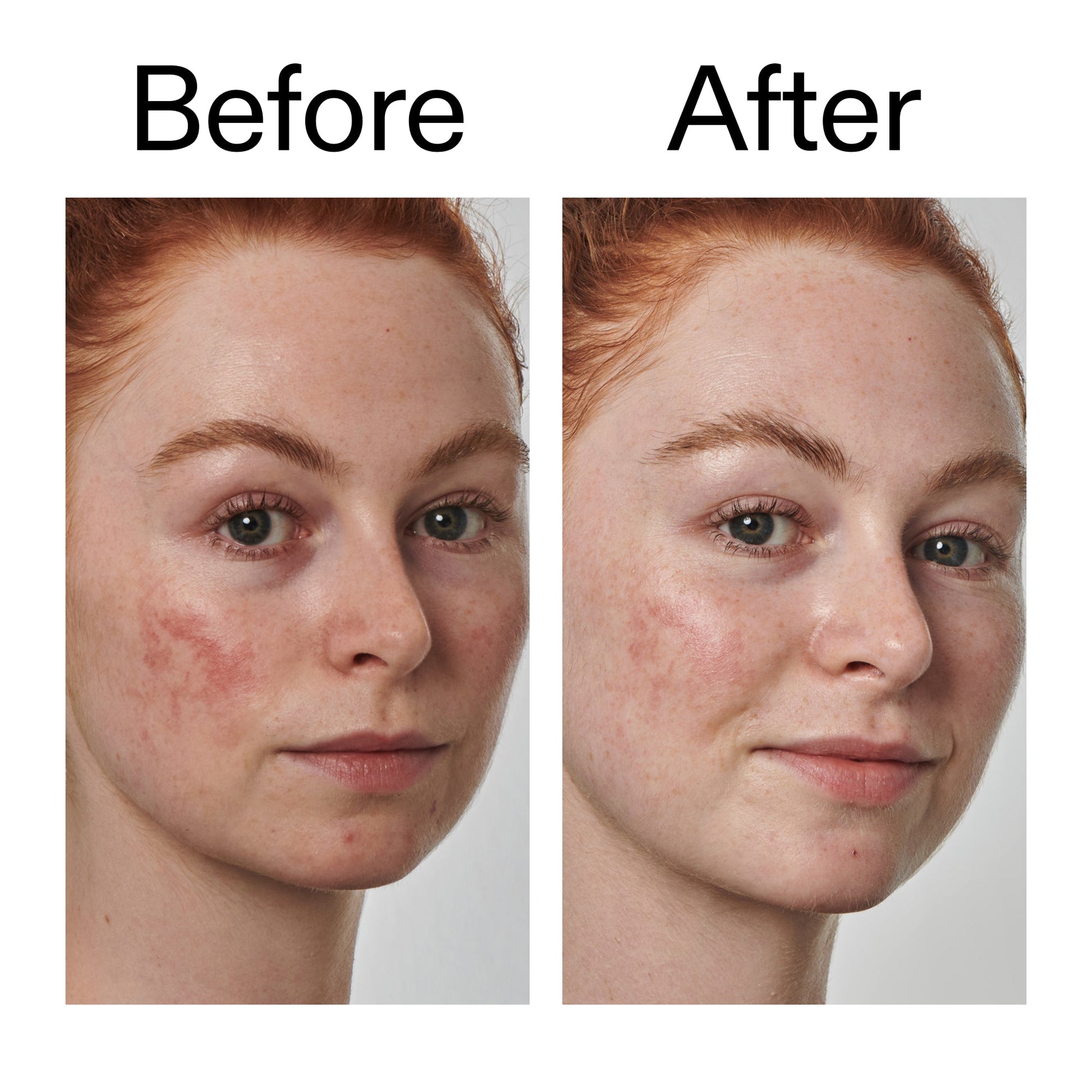 10-azelaic-acid-serum-for-redness-relief-g0 Redness_Relief_Serum_Before_After_2000x2000_3334dc9a-cce9-4e00-8aec-7ad89ca051f2.jpg