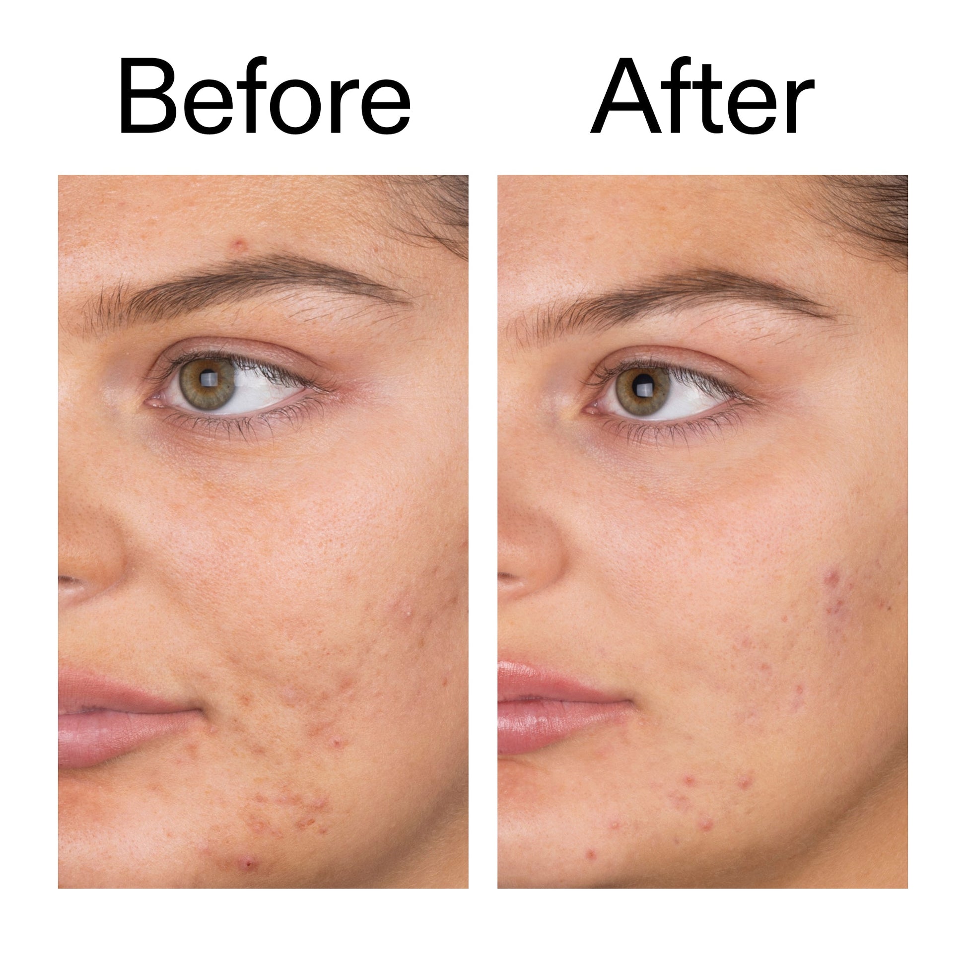 salicylic-acid-cleanser-duo-g5 Salicylic_Acid_Cleanser_-_150ml_Before_After_2000x2000_e7230494-853f-4b07-82b1-27669104c995.jpg