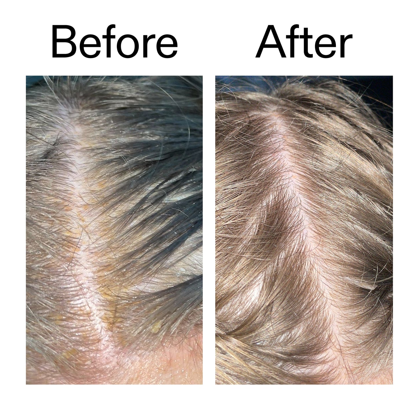 salicylic-acid-exfoliating-scalp-treatment-w8 Salicylic_Acid_Exfoliating_Scalp_Treatment_Before_After_2000x2000_e572a30f-057c-4a48-823b-1c09dc97f8d0.jpg
