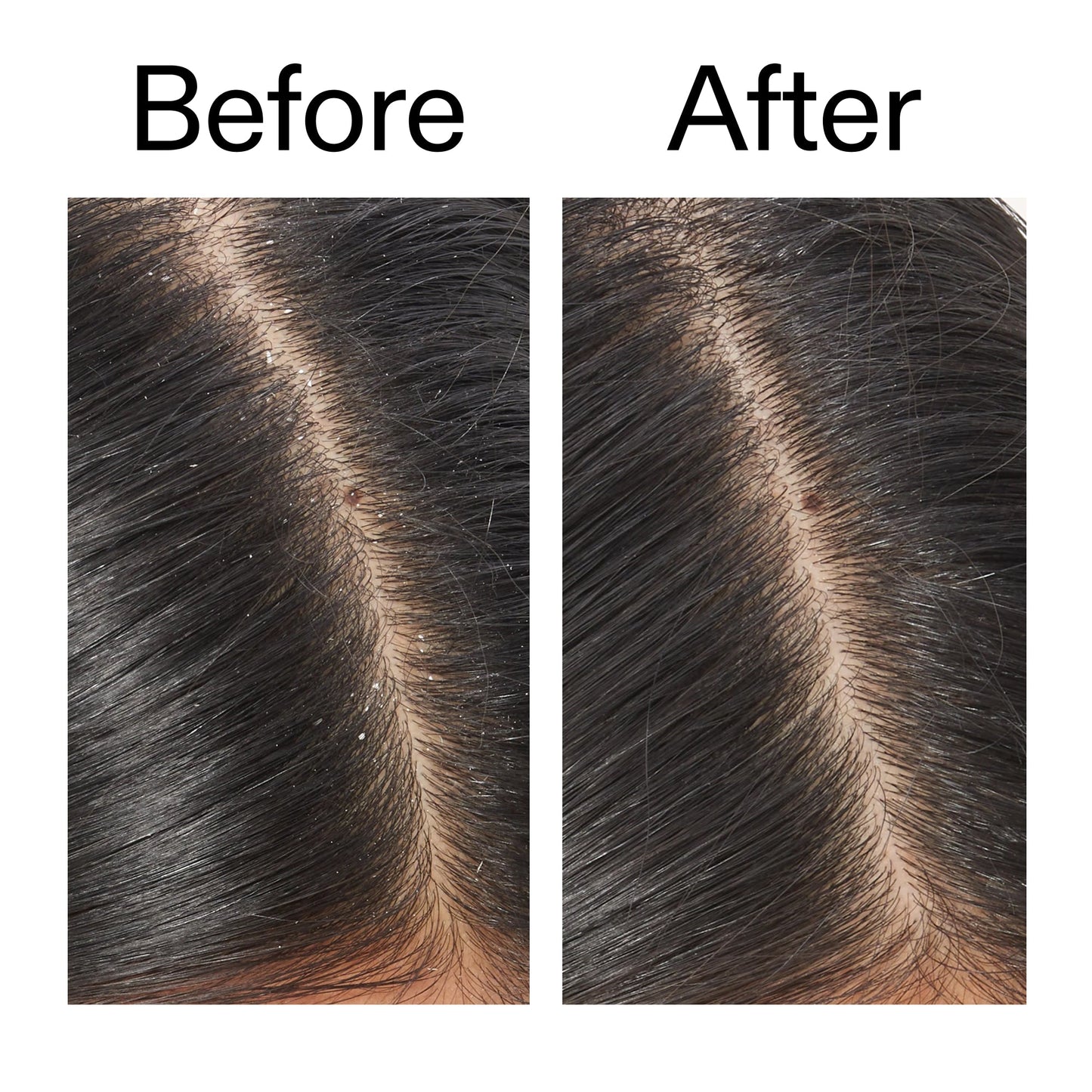 salicylic-acid-exfoliating-scalp-treatment-w8 Salicylic_Acid_Exfoliating_Scalp_Treatment_Before_After_V2_2000x2000_02bd61ad-42bf-490b-b3e3-7e04b2e8a673.jpg