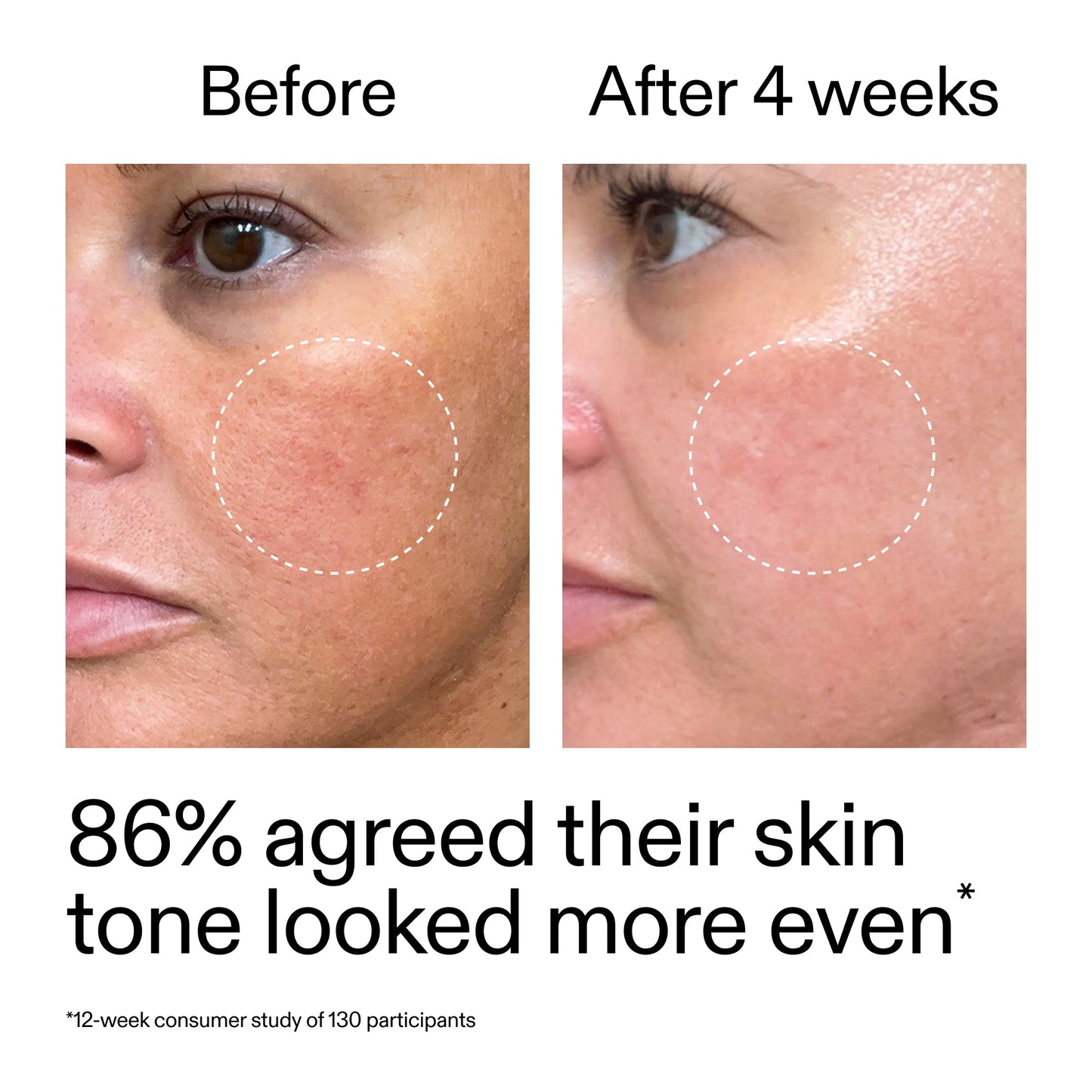 starter-retinol-serum-w1 StarterRetinol_BeforeAfter_Claim2_2000x2000_f5c9ecc0-8d76-429d-bef5-c3a61bcf5c09.jpg
