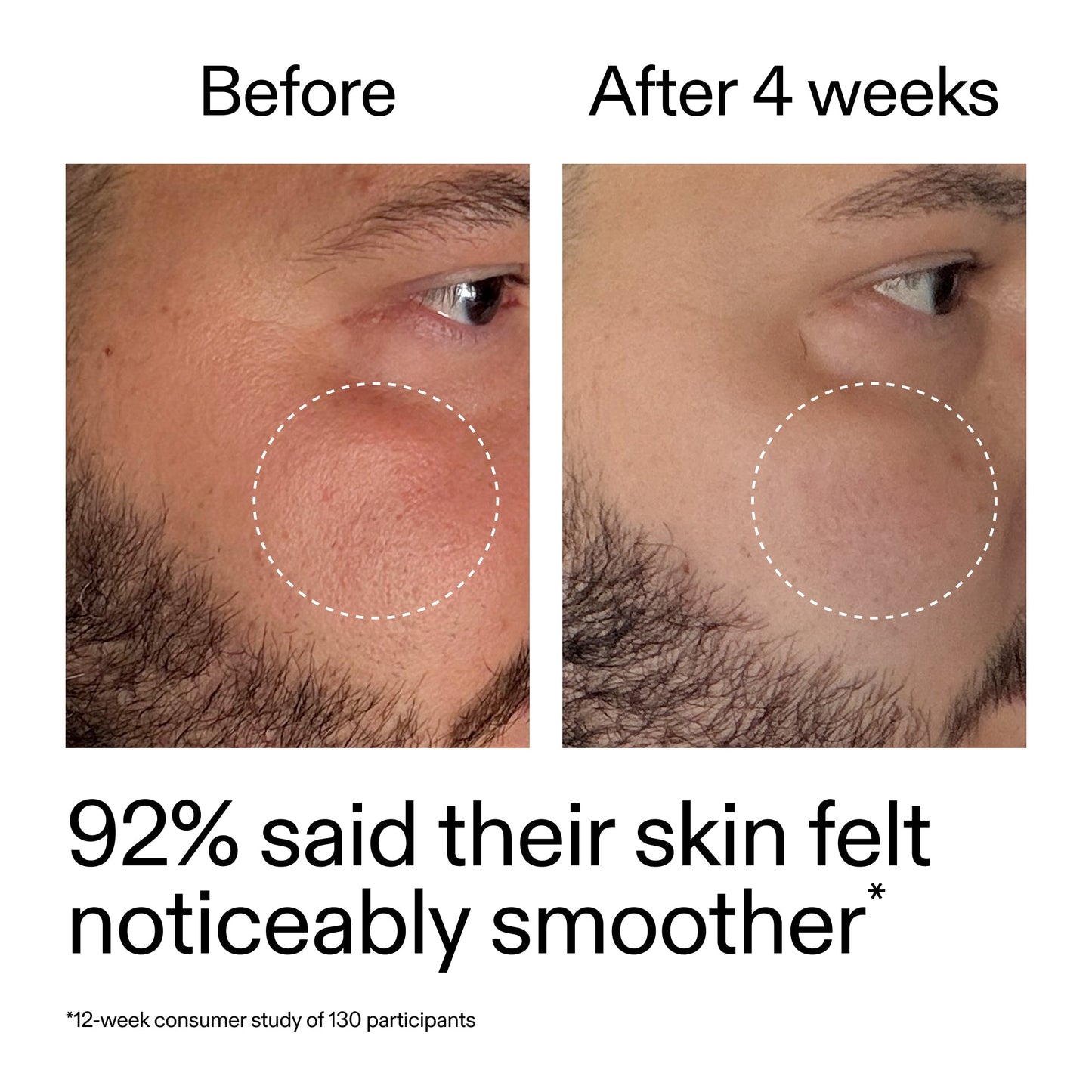 starter-retinol-serum-w1 StarterRetinol_BeforeAfter_Claim3_2000x2000_6ceab106-e0ee-4ed4-ba62-41bc39538038.jpg