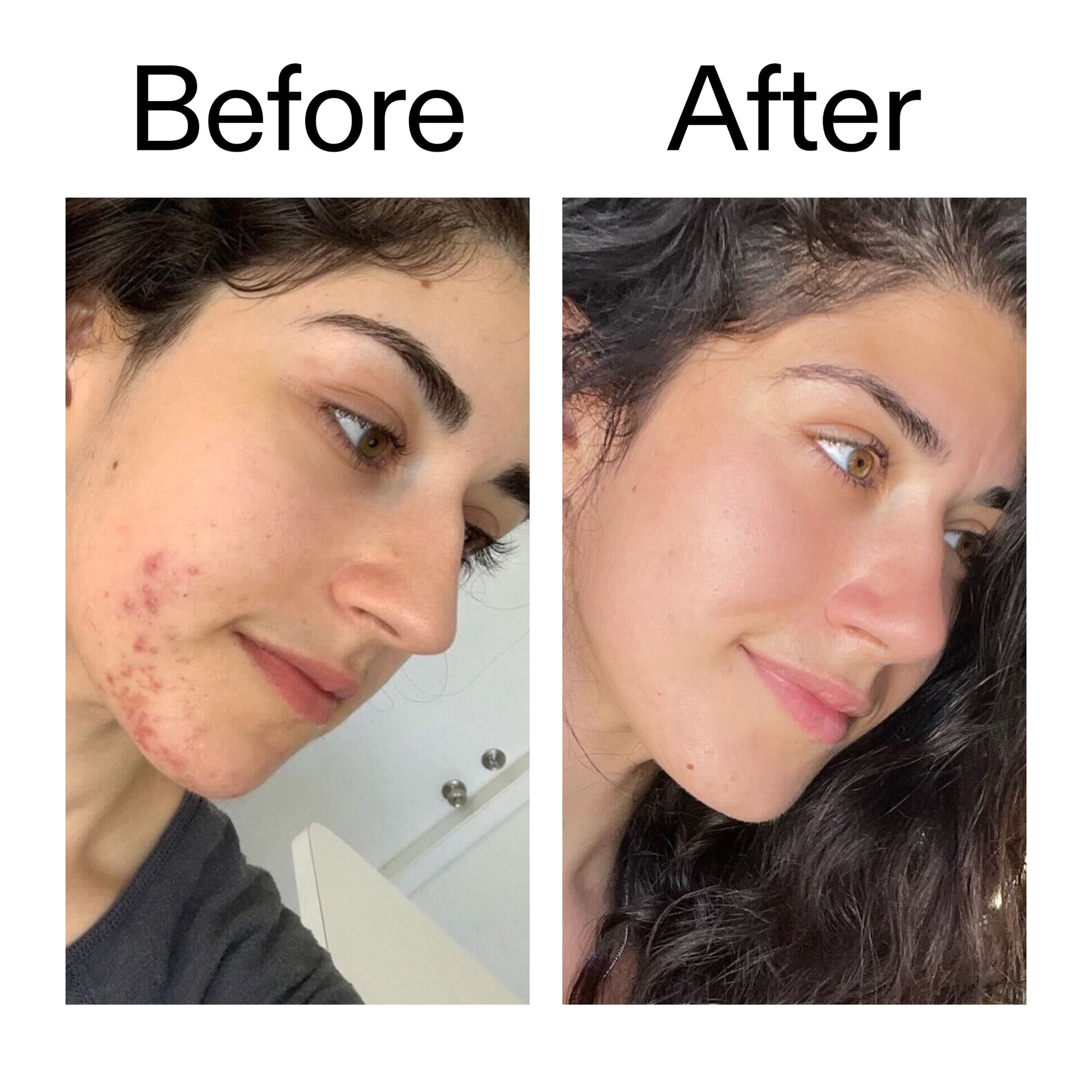 succinic-acid-acne-treatment-k6 Succinic_Acid_Treatment_Before_After_2000x2000_6a5f0054-2f58-4433-9314-0dc72c9bdd3b.jpg