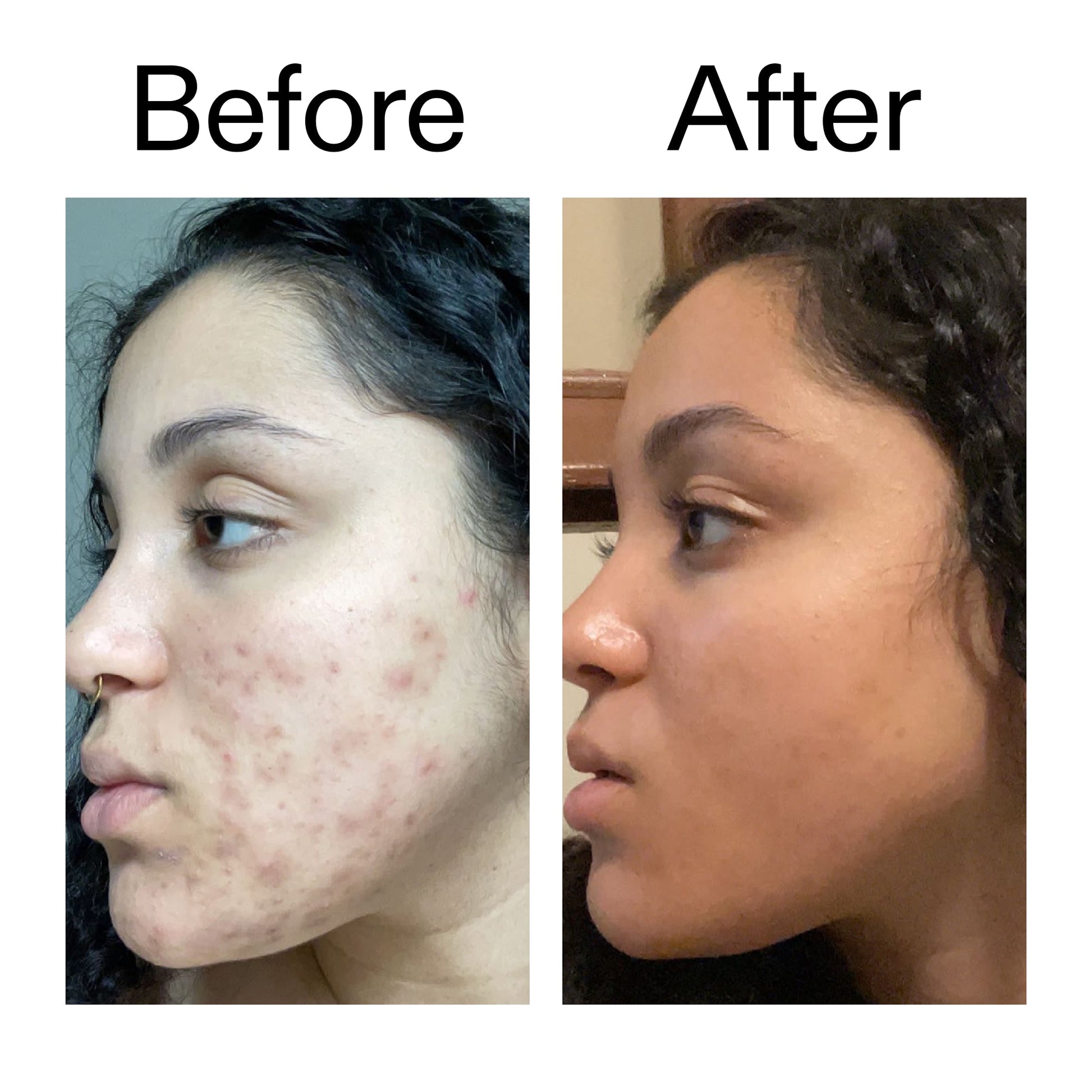 tranexamic-acid-serum-z8 Tranexamic_Acid_Serum_Before_After_2000x2000_98ebc8be-77b0-4843-8a22-90790ebe918b.jpg